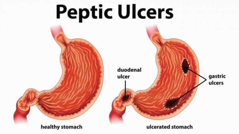 overuse-of-these-drugs-can-lead-to-peptic-ulcer-disease-rafamall