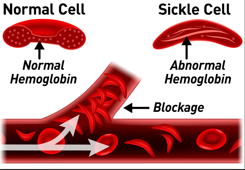 sickle-cell-disease-diagram