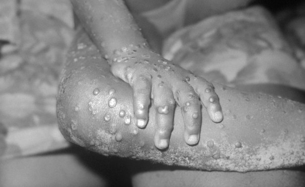 Nigeria: Monkeypox in Nigeria – Why the Disease Needs Intense Management